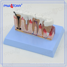 PNT-0528cc Dental Teeth models and Implants Communication Model for Dentist